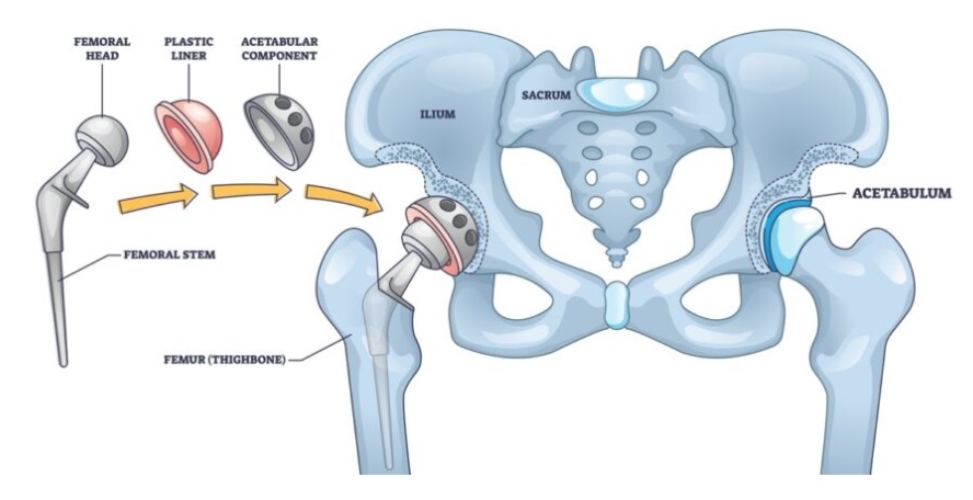 الأنشطة بعد عملية استبدال الورك