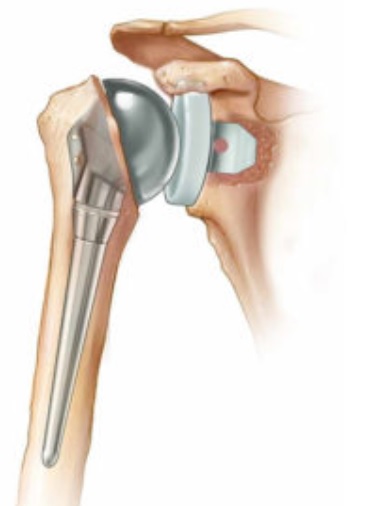 نصائح  بعد استبدال مفصل الكتف