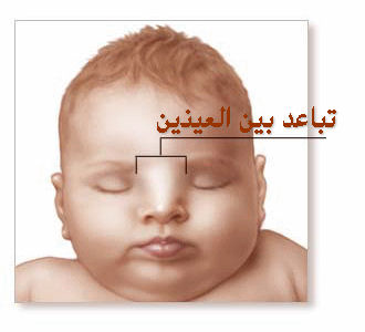 متلازمة وردينبيرج Waardenburg Syndrome