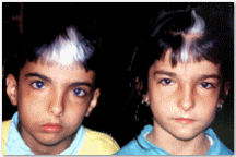 متلازمة وردينبيرج Waardenburg Syndrome