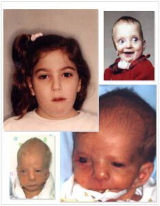 متلازمة جولدنهار